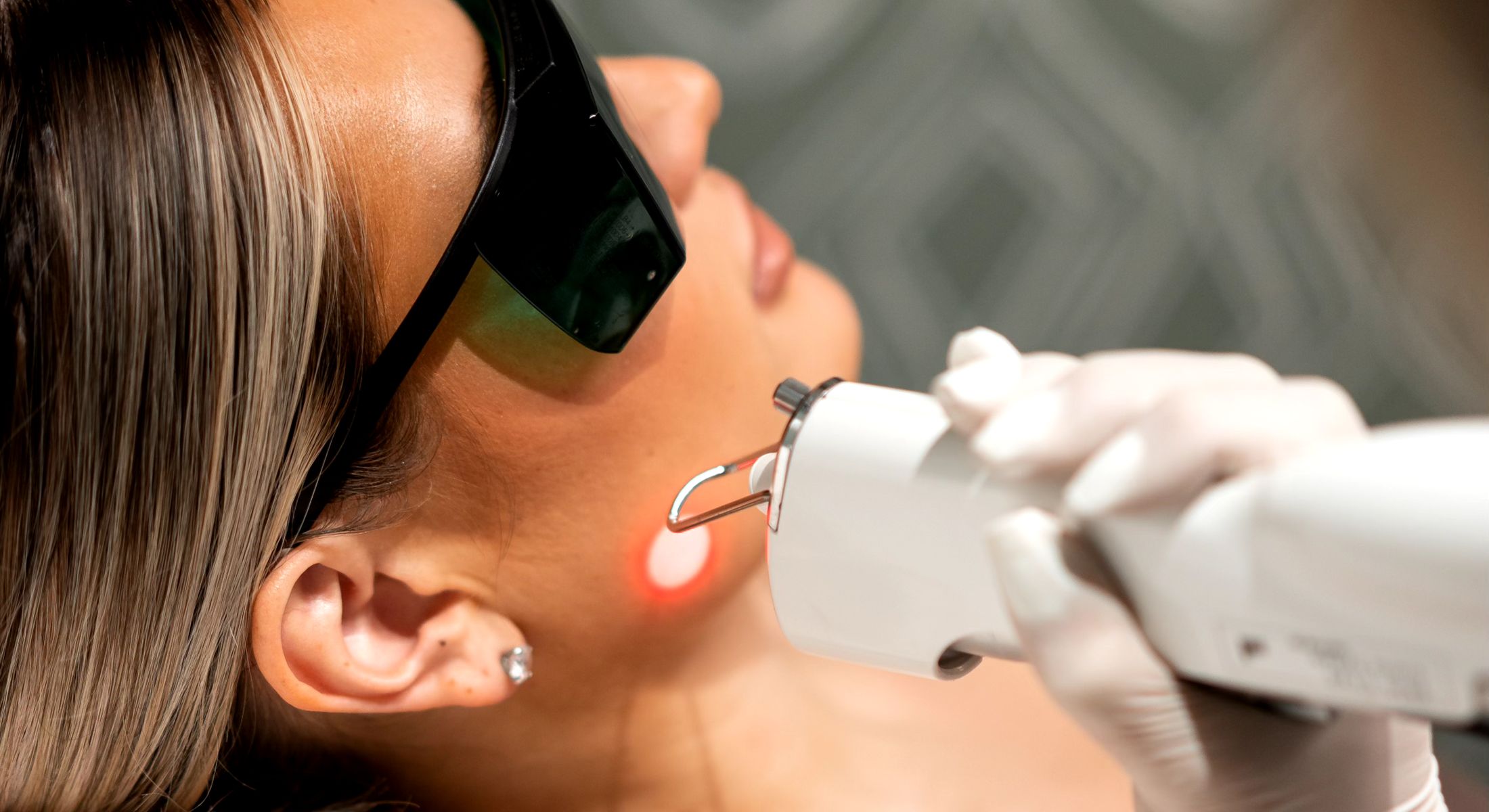 Woman receiving a laser hair removal treatment in Denver, CO